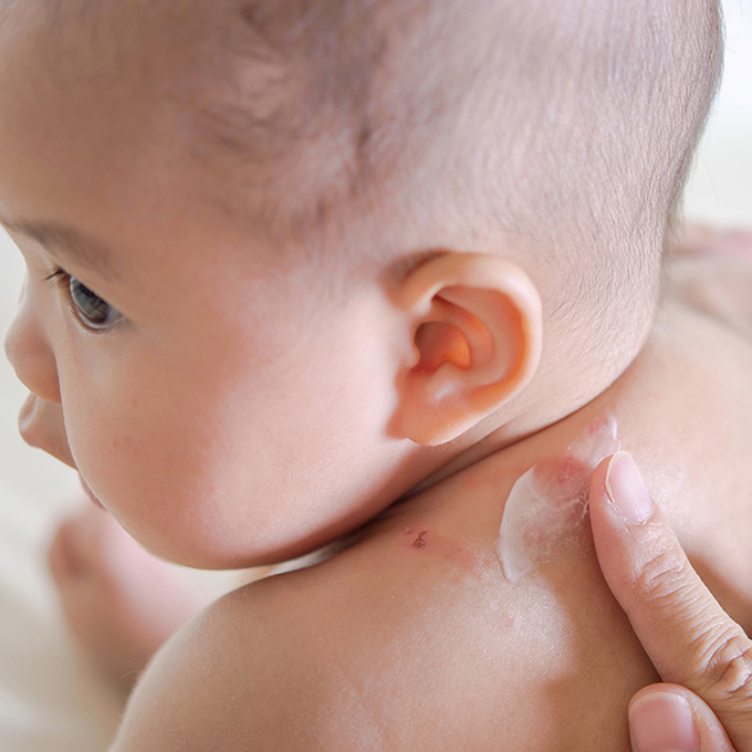 Riconoscere le Punture degli Insetti